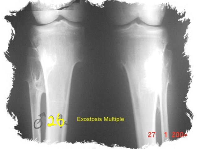 |Hereditary multiple exostoses